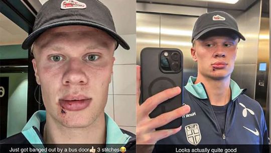Bizarne zranenie norskej hviezdy Haalanda